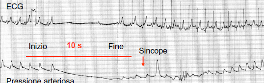 Massaggio del seno carotideo Esecuzione Supino: massaggio a Dx 10 sec Supino: