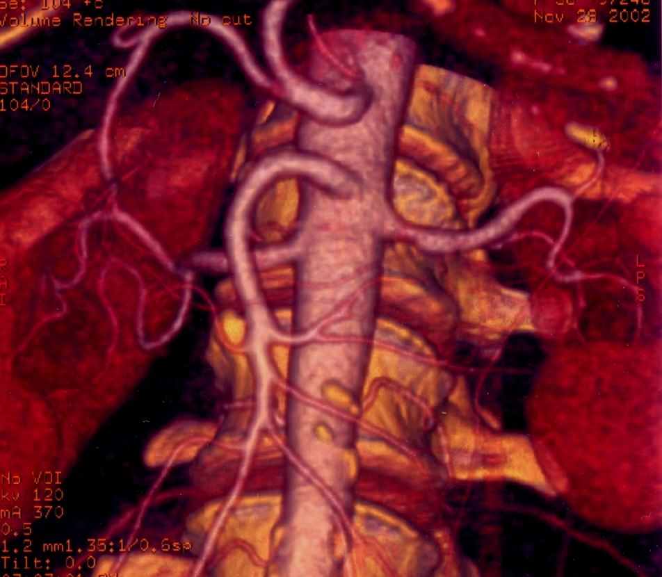 MULTI SLIDE CT Combina vantaggi della TC e dell angiografia Elimina la necessità di ricorrere all angiografia Permette ricostruzioni 3D Test di scelta nella diagnosi di rottura di aneurisma