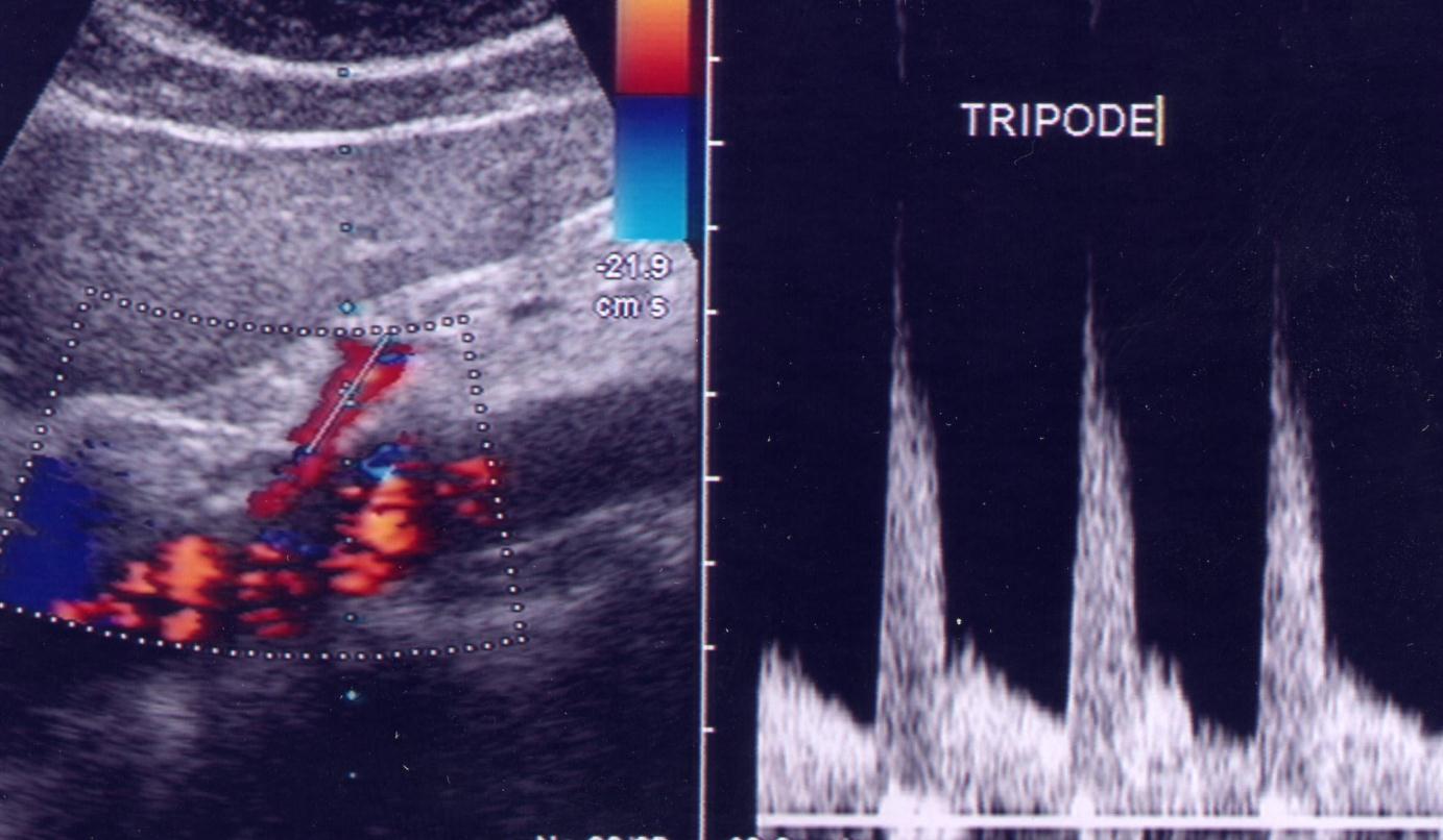 ANATOMIA ECOGRAFICA COLLATERALI TRIPODE CELIACO Color-doppler semplifica lo studio del vaso Velocitogramma