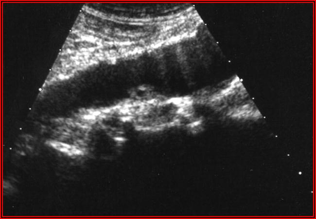 PATOLOGIA STENO OSTRUTTIVA Nel pz uremico la presenza di placche parietali è una reperto molto ATEROMI FIBROADIPOSI : iperecogeni rispetto al sangue frequente ed in genere asintomatico circolante;