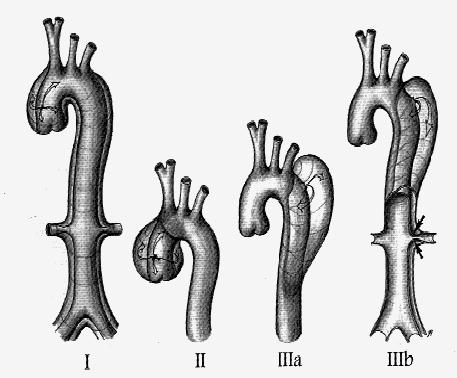 Può essere localizzata: 65 % Porzione ascendente arco aortico 10 % Arco aortico 20 % Tratto prossimale aorta discendente 5 % Aorta addominale Classificazione di De Bakey Tipo I: dissecazione nasce