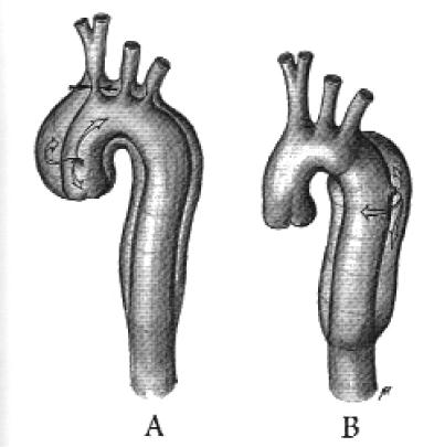 Classificazione di Stanford Tipo A (prossimale) : se coinvolge l aorta ascendente e/o arco Tipo B (distale):