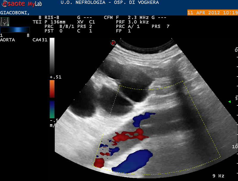 COLOR-DOPPLER Evidenzia un riempimento asincrono dei due lumi con colorazione alternata (ben evidente quando non vi è orificio di rientro della dissezione)