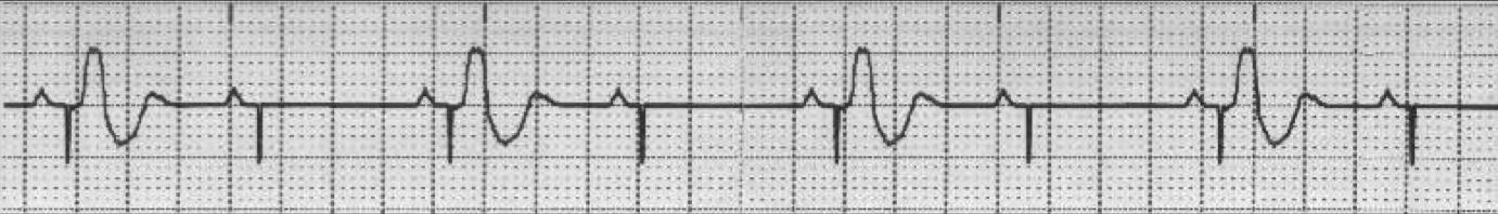 2.Se l artefatto di stimolazione è visibile deve essere seguito da un onda P o da un complesso QRS A meno che la stimolazione non sia coincidente con l attività spontanea della camera cardiaca, l