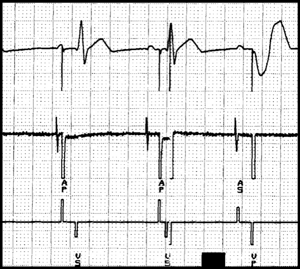 Figura 9 In corso di ritmo sinusale e normale conduzione AV vi può essere una stimolazione ventricolare di sicurezza in caso di deficit di sensing atriale, qualora la stimolazione atriale coincida