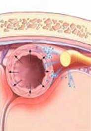 Fisiopatologia dell emicrania cronica 1. Ridotta inibizione centrale 2.