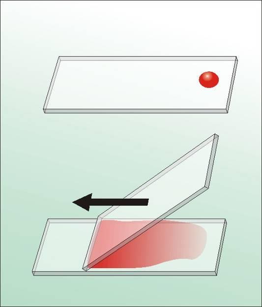 lo striscio di sangue Lo striscio consente lo studio microscopico delle