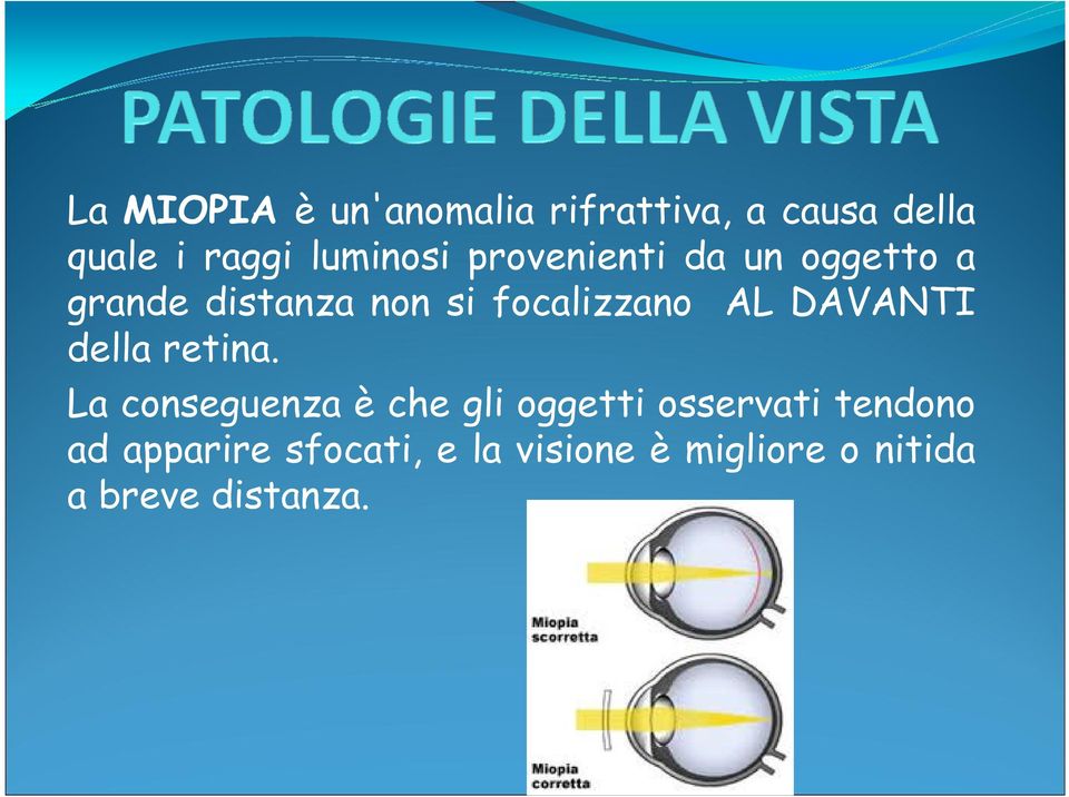 focalizzano AL DAVANTI della retina.