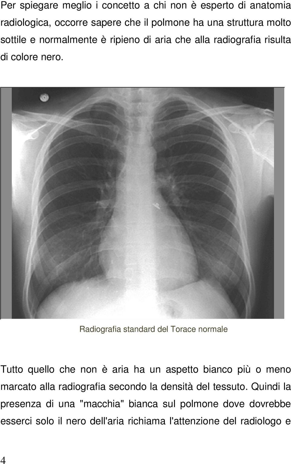 Radiografia standard del Torace normale Tutto quello che non è aria ha un aspetto bianco più o meno marcato alla radiografia
