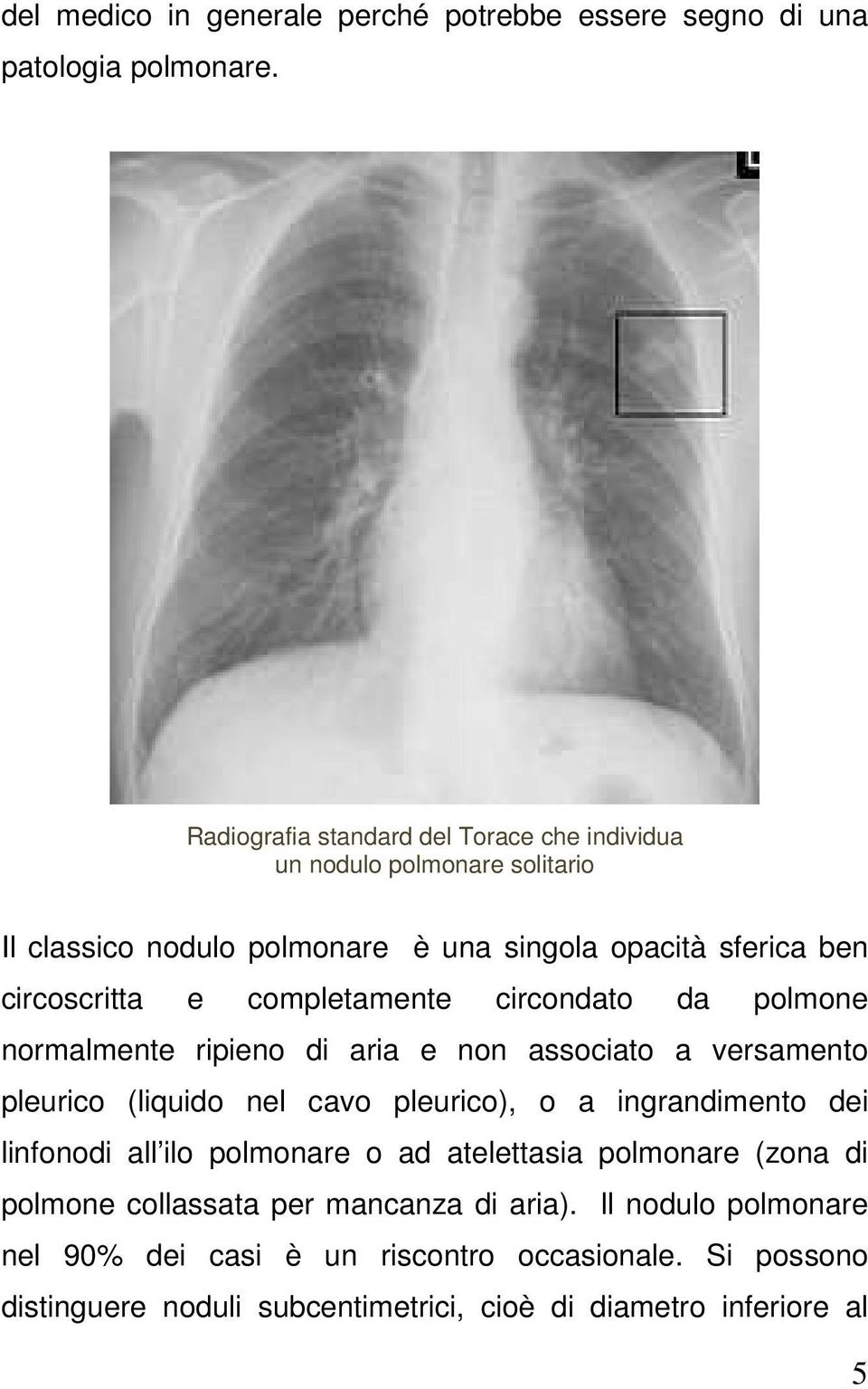 completamente circondato da polmone normalmente ripieno di aria e non associato a versamento pleurico (liquido nel cavo pleurico), o a ingrandimento dei