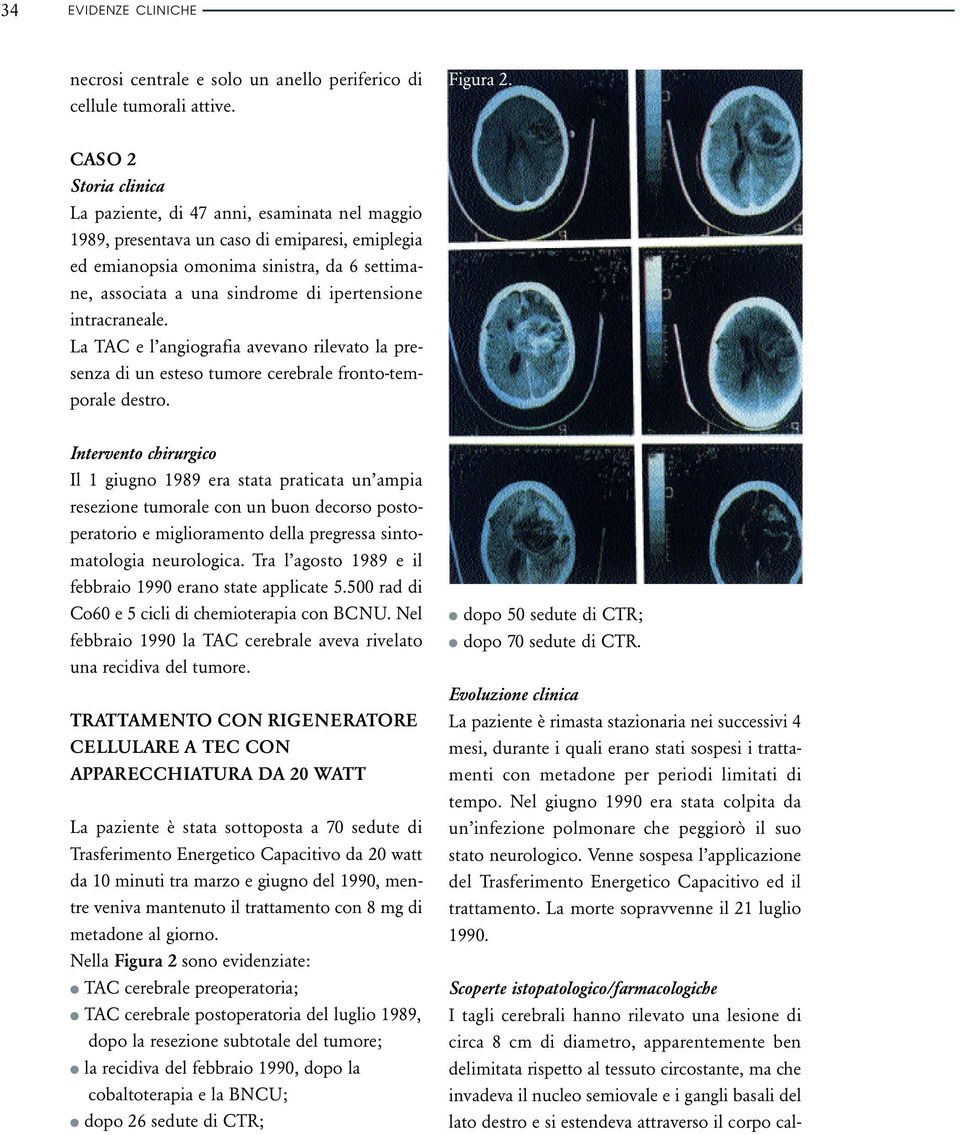 ipertensione intracraneale. La TAC e l angiografia avevano rilevato la presenza di un esteso tumore cerebrale fronto-temporale destro.