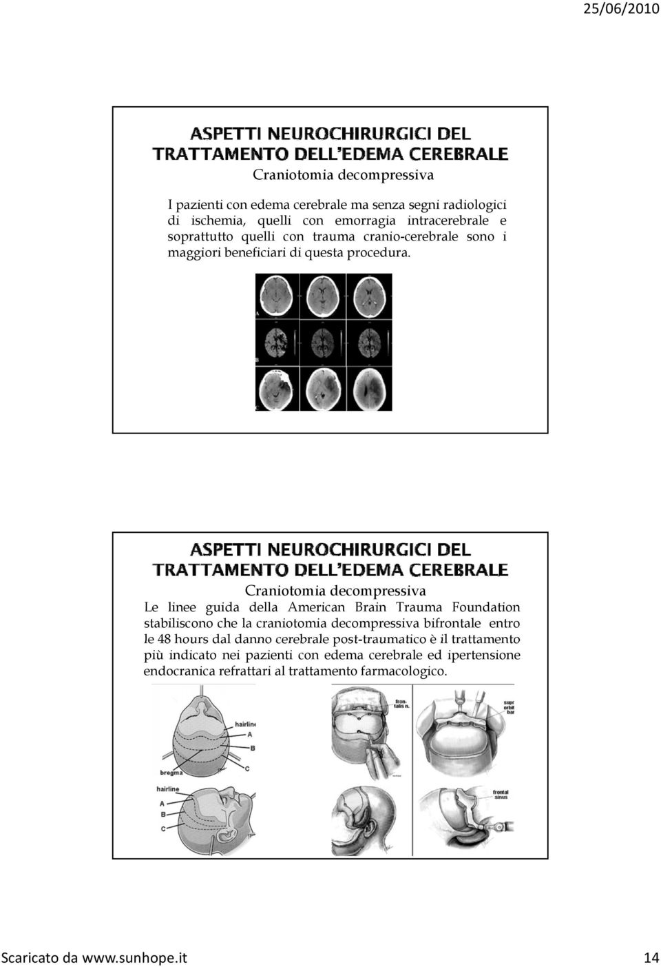 Craniotomia decompressiva Le linee guida della American Brain Trauma Foundation stabiliscono che la craniotomia decompressiva bifrontale entro le 48