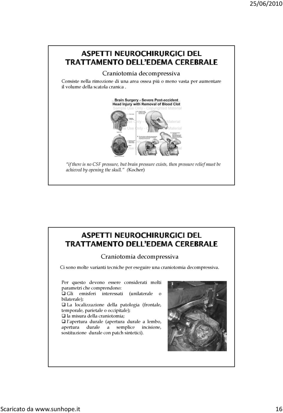 (Kocher) Craniotomia decompressiva Ci sono molte varianti tecniche per eseguire una craniotomia decompressiva.