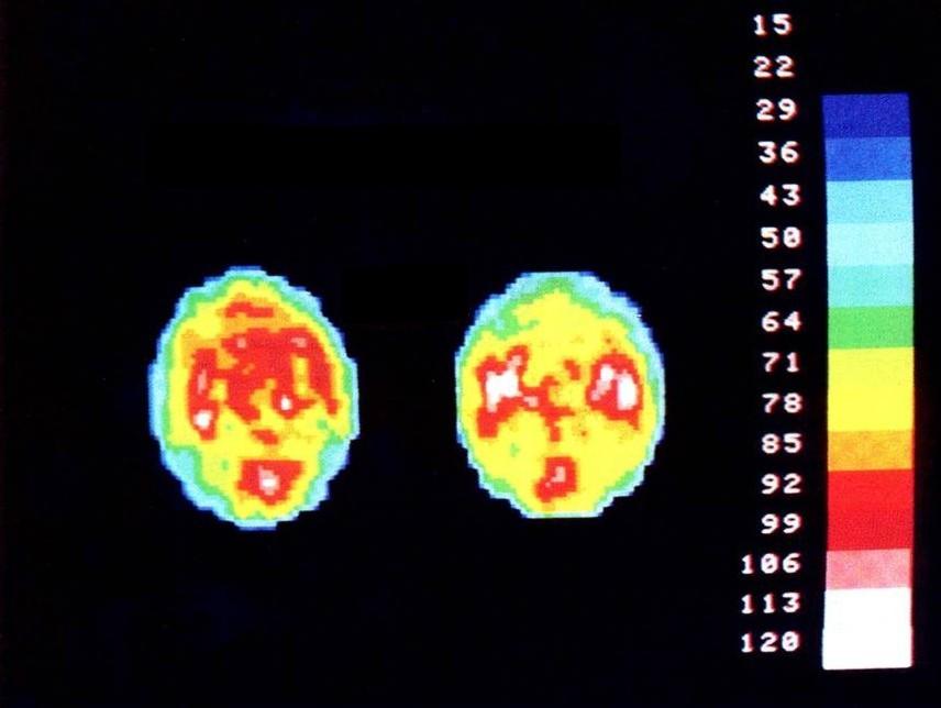 Neuroanatomica Neurochimica Neurofisiologia flusso ematico SPECT Normale