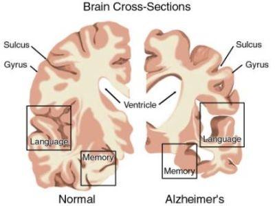 AREE ENCEFALICHE COINVOLTE I. Gangli della base contenenti acetilcolina, neurotrasmettitore importante per memoria e apprendimento.