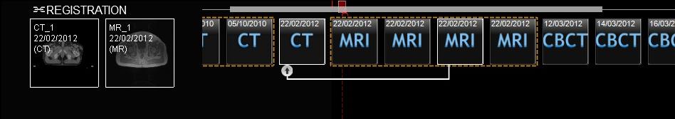 SBRT and (Extreme)