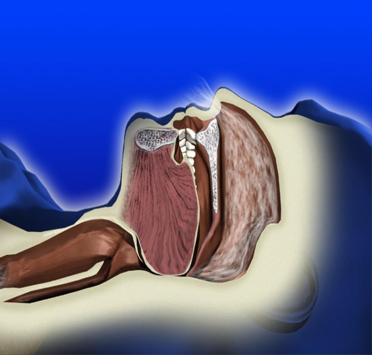 apnea ostruttiva CPAP L aumento della