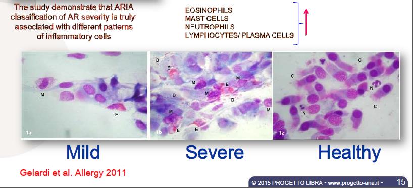 Nei pazienti moderato-gravi si riscontra un elevata presenza di mastociti, eosinofili e linfoplasmacellule e quindi IgEs a livello della mucosa nasale Una minor produzione di IgEs è sicuramente un