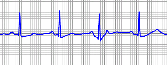 ICD-S: riconoscimento del ritmo 3 vettori di sensing Selezione automatica del segnale ottimale 2 zone di riconoscimento Verifica sensing pre-impianto 400 300 200 150 100 90 80 70 60 50 40 30 HEART
