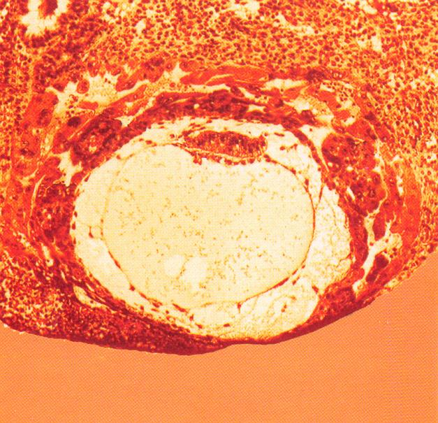 il numero e la permeabilità EDEMA MATRICE EXTRACELLULARE - perdita di fibre collagene CELLULE