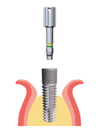 INSERIMENTO IMPIANTO MANUALE INSERIMENTO IMPIANTO CON MICROMOTORE Chiave W-Start Chiave motore W-Start Prelevare l impianto way Extra dal Touch & go con la chiave W-Start, identificabile dalla