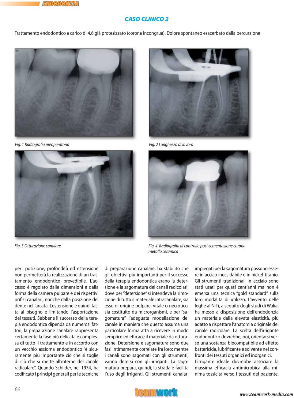 4 Radiografia di controllo post cementazione corona metallo ceramica per posizione, profondità ed estensione non permetterà la realizzazione di un trattamento endodontico prevedibile.