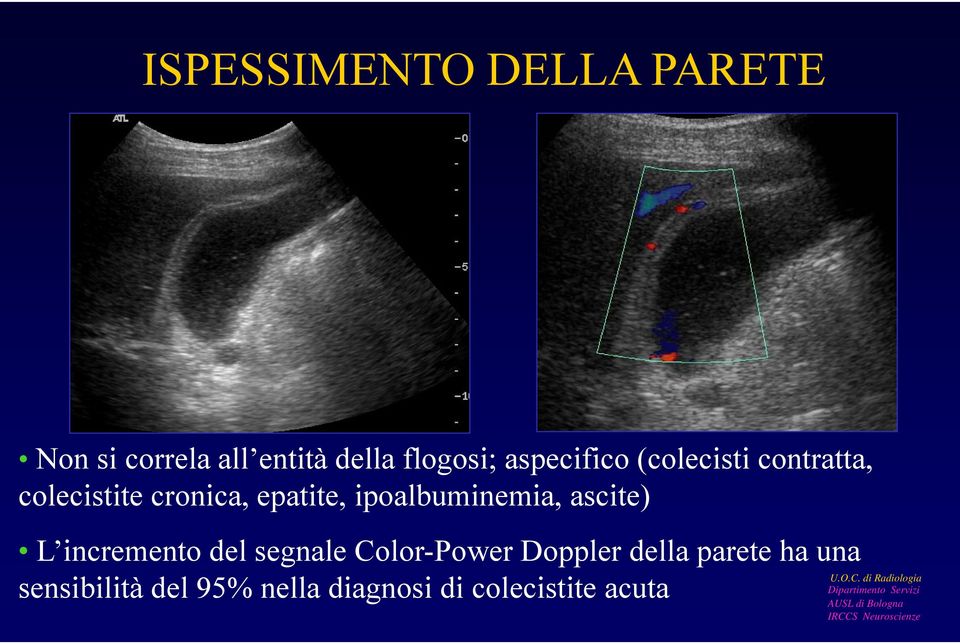 ipoalbuminemia, ascite) L incremento del segnale Color-Power Doppler