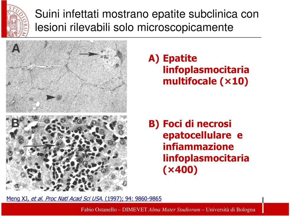 10) B) Foci di necrosi epatocellulare e infiammazione