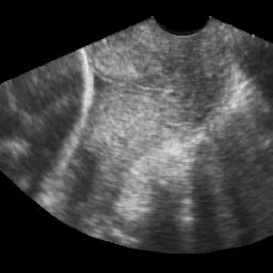 Cervice dinamica Significato incerto Spesso associata a cervice corta Nelle pazienti sintomatiche la minima lunghezza cervicale misurata funziona meglio nella predizione del