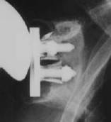 Risultati Protesi anatomica FU: 36-48 mesi JSES 2002 Tasso di sopravvivenza metal-backed non cementato