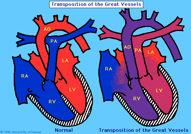 Trasposizione dei Grossi vasi: Discordanza ventricolo