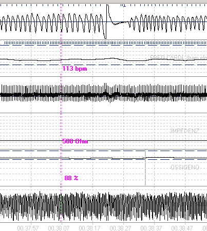 comparsa di desaturazione