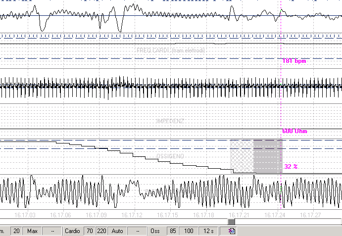 Irregolarità del respiro