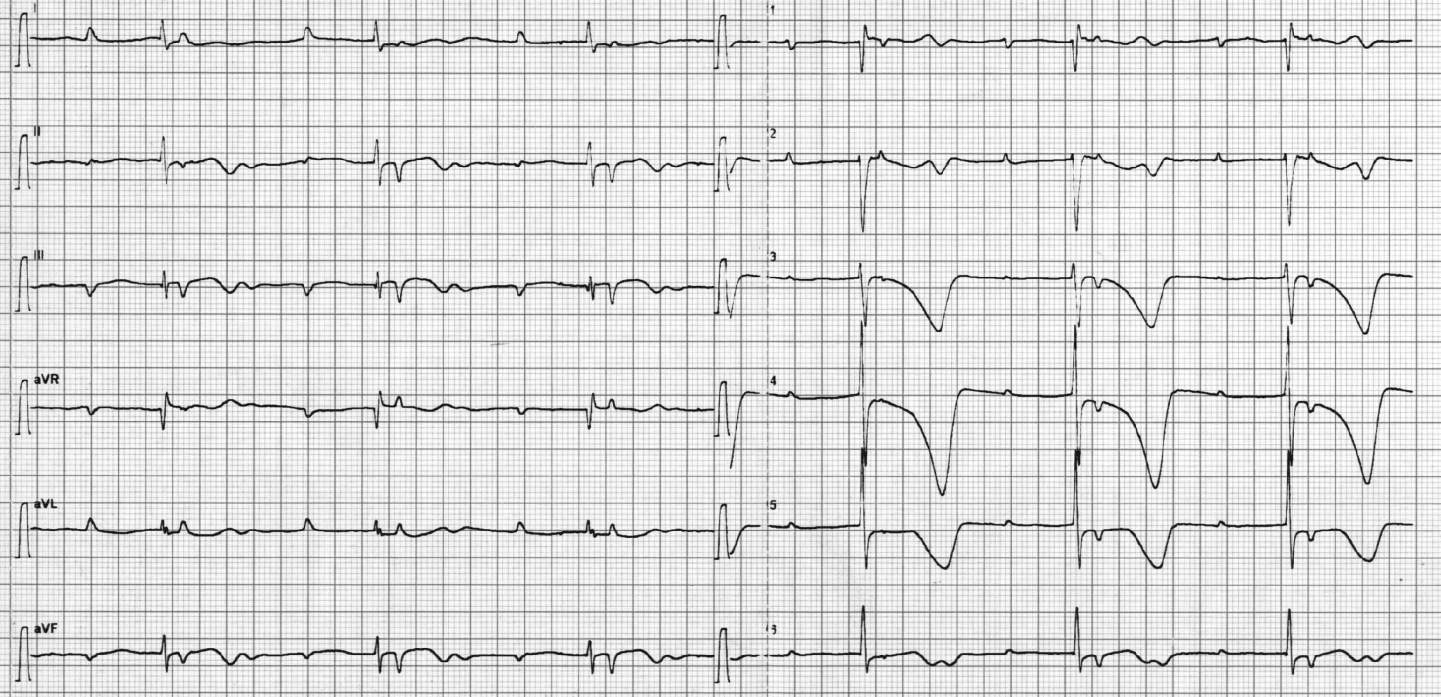 MB, 8 anni A casa, due episodi sincopali a riposo, uno in bagno, rapida ripresa ECG PS Discusso caso con nostro