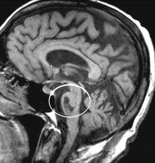 LESIONI DEL PONTE 1. Lesione del nucleo del VI n.c. 2. Lesione Fascicolare del VI n.c. 3. Lesione del PPRF 4.