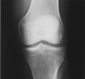 3 LA PROTESI DEL GINOCCHIO Quando l articolazione del ginocchio è danneggiata a causa di una malattia degenerativa, come l artrosi o l artrite reumatoide, o traumatica, si può recuperare la sua