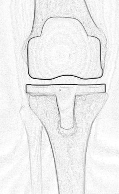 4 Esistono molti modelli di protesi del ginocchio, generalmente caratterizzati da tre componenti: * la componente femorale ha la forma di una capsula metallica e ricopre i condili femorali; * la