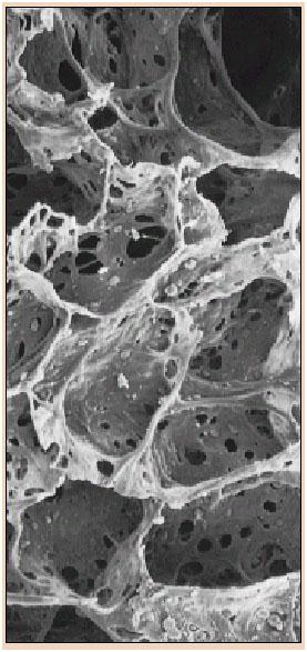 Alterazioni nel parenchima polmonare Distruzione delle pareti alveolari Perdita di ritorno elastico Distruzione del letto