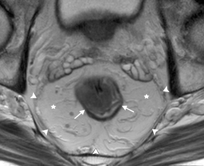 Margine di resezione circonferenziale Relazione tra la massa tumorale e la fascia