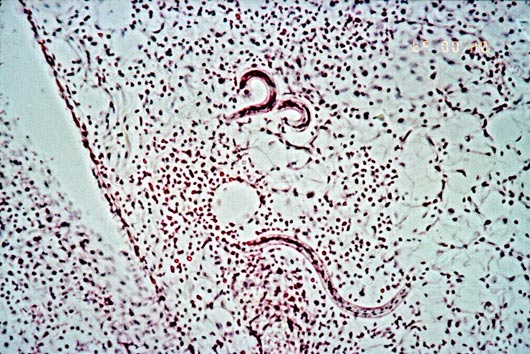 Figura ni11 Ancylostoma duodenale: Ciclo di vita. I vermi adulti vivono nel lume del piccolo intestino, dove si attaccano alla parete intestinale producendo perdite di sangue nell ospite.