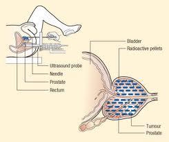 3) La radioterapia La radioterapia è quella branca della medicina specialistica che impiega le radiazioni per produrre un effetto radiobiologico distruttivo sul tessuto neoplastico.