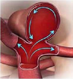 PSEUDOANEURISMA DEFINIZIONE: Lo pseudoaneurisma postcateterismo ( PSA ) è una cavità extravascolare delimitata da una capsula reattiva di tessuto