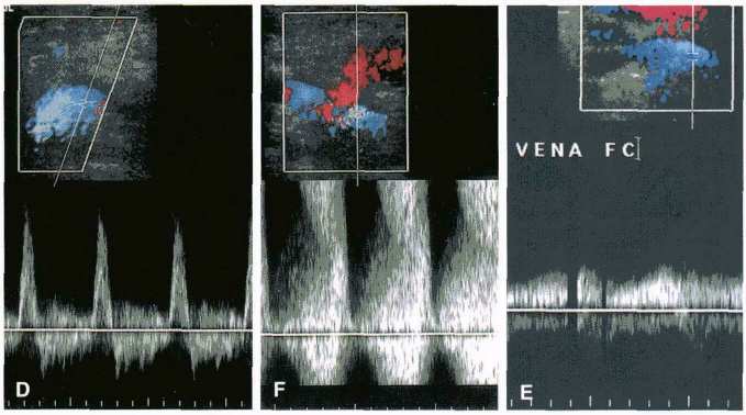 Principali quadri lesionali Fistola artero-venosa (FAV) Si può definire come comunicazione diretta tra il sistema arterioso ed il sistema venoso, senza interposizione della rete capillare.