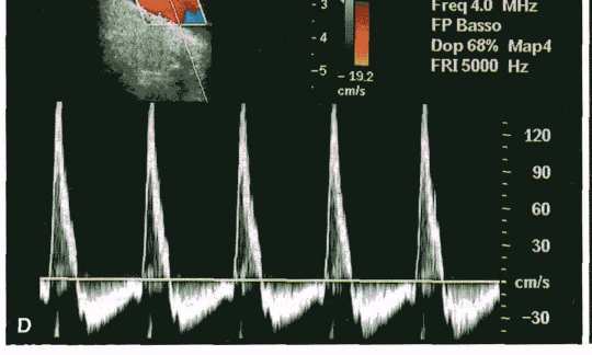 Principali quadri lesionali Al Doppler pulsato si apprezza flusso in entrambi i lumi con