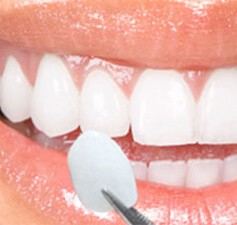 Faccette in ceramica Le faccette dentali in ceramica, note anche come veneers, sono sottili fogli di ceramica, sempre realizzati in laboratorio che vengono applicati, con una metodologia veloce e