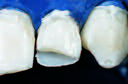 Tecnica diretta a) Mordenzatura dello smalto: acido ortofosforico al 37% in gel; i tempi di applicazione sono gli stessi che vengono utilizzati nel substrato dentinale (30, 60 ); b) Mordenzatura