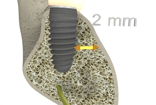 All'impianto viene poi collegato il moncone (abutment) tramite una vita di