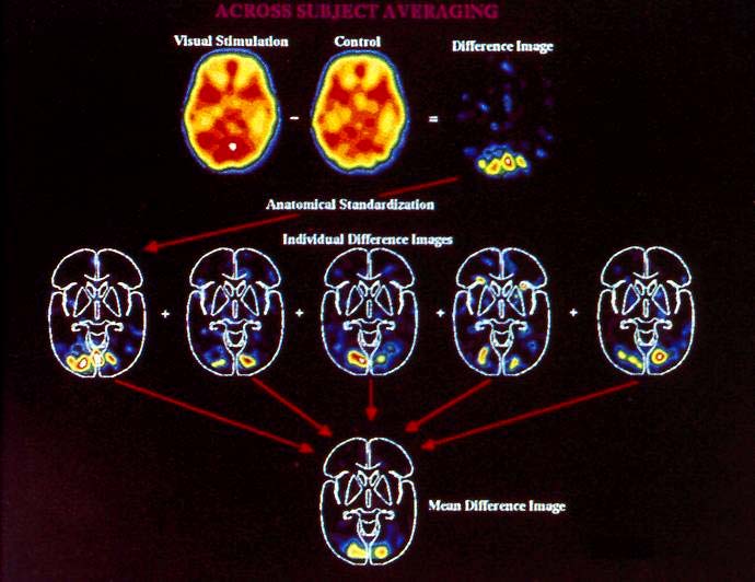 Studio in vivo delle funzioni cerebrali: elaborazione dei dati acquisiti con metodologia PET ATTIVAZIONE RIPOSO CONTROLLO