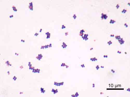 Spettro microbiologico Stafilococco aureus Agente eziologico 30% casi con elevata incidenza di MRSA (20-30% ) In alcune casistiche MRSA ha completamente soppiantato MSSA