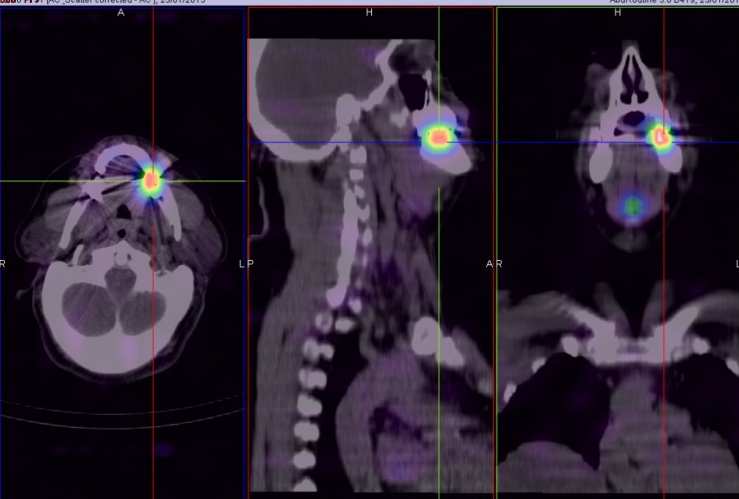 SPECT/CT con